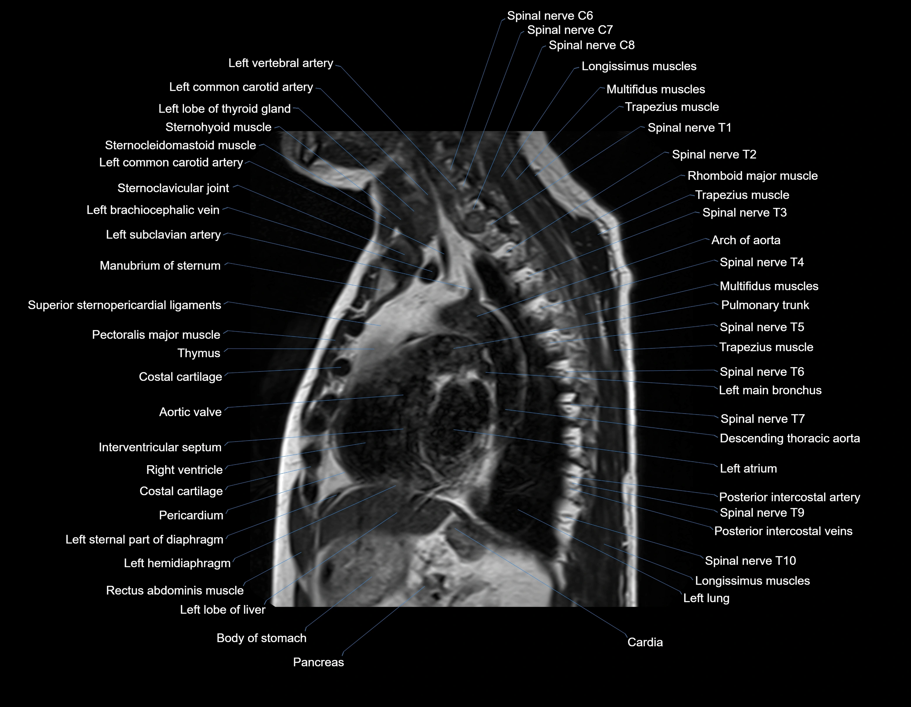 MRI chest (thorax) sagittal labelled cross sectional anatomy 3T radiology image-img-00001-00022.webp